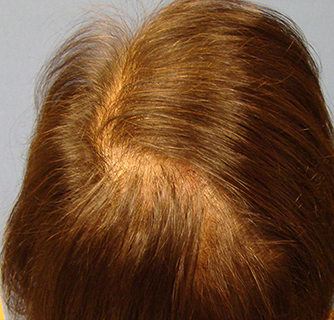 Laser Therapy Hair Restoration for Women Case Before Photo