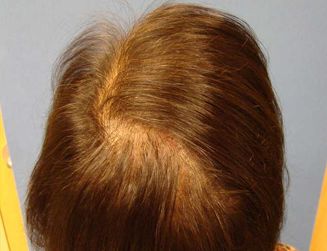 Laser Therapy Hair Restoration for Women Case Before Photo