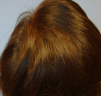 Laser Therapy Hair Restoration for Women Case After Photo