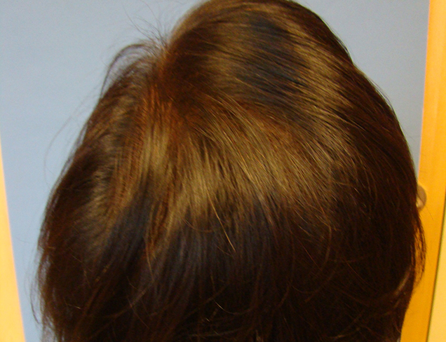 Laser Therapy Hair Restoration for Women Case After Photo