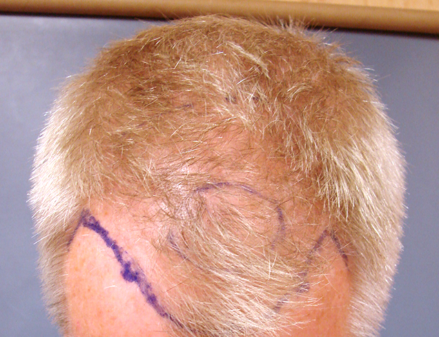 Neograft Hair Restoration Case Before Photo
