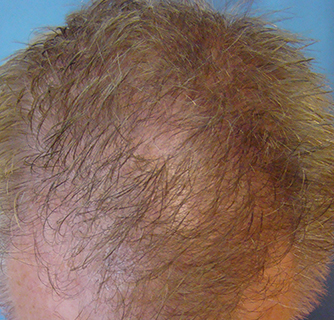 Neograft Hair Restoration Case After Photo