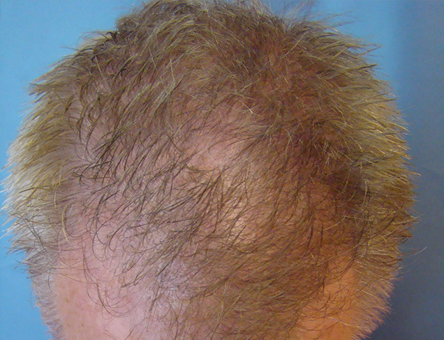 Neograft Hair Restoration Case After Photo