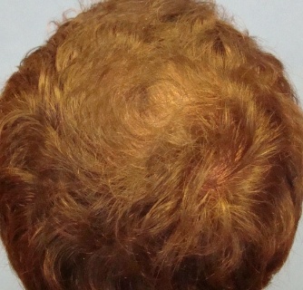 Platelet-Rich Plasma Treatment Case After Photo