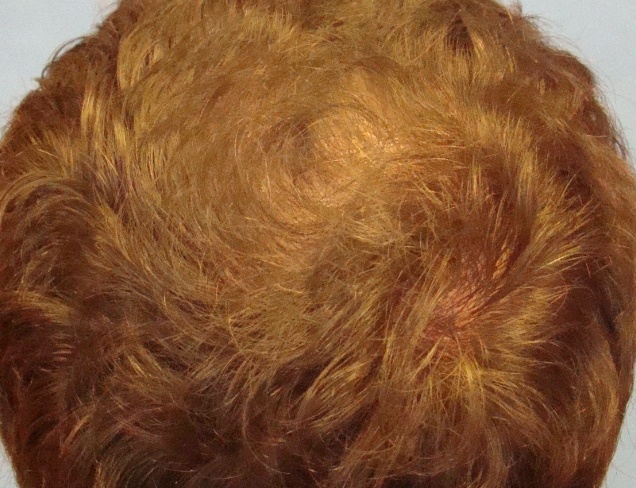 Platelet-Rich Plasma Treatment Case After Photo